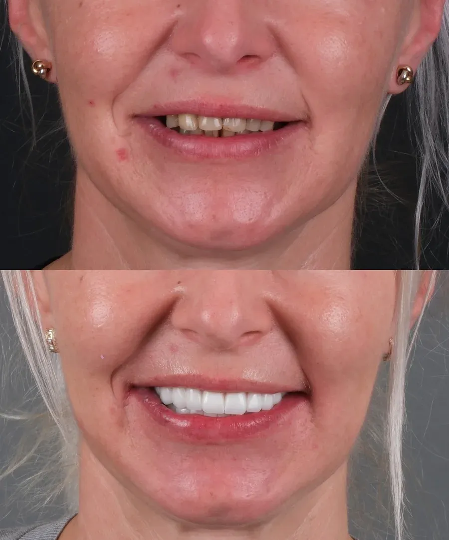 Before and after dental treatment result at DNT Klinik