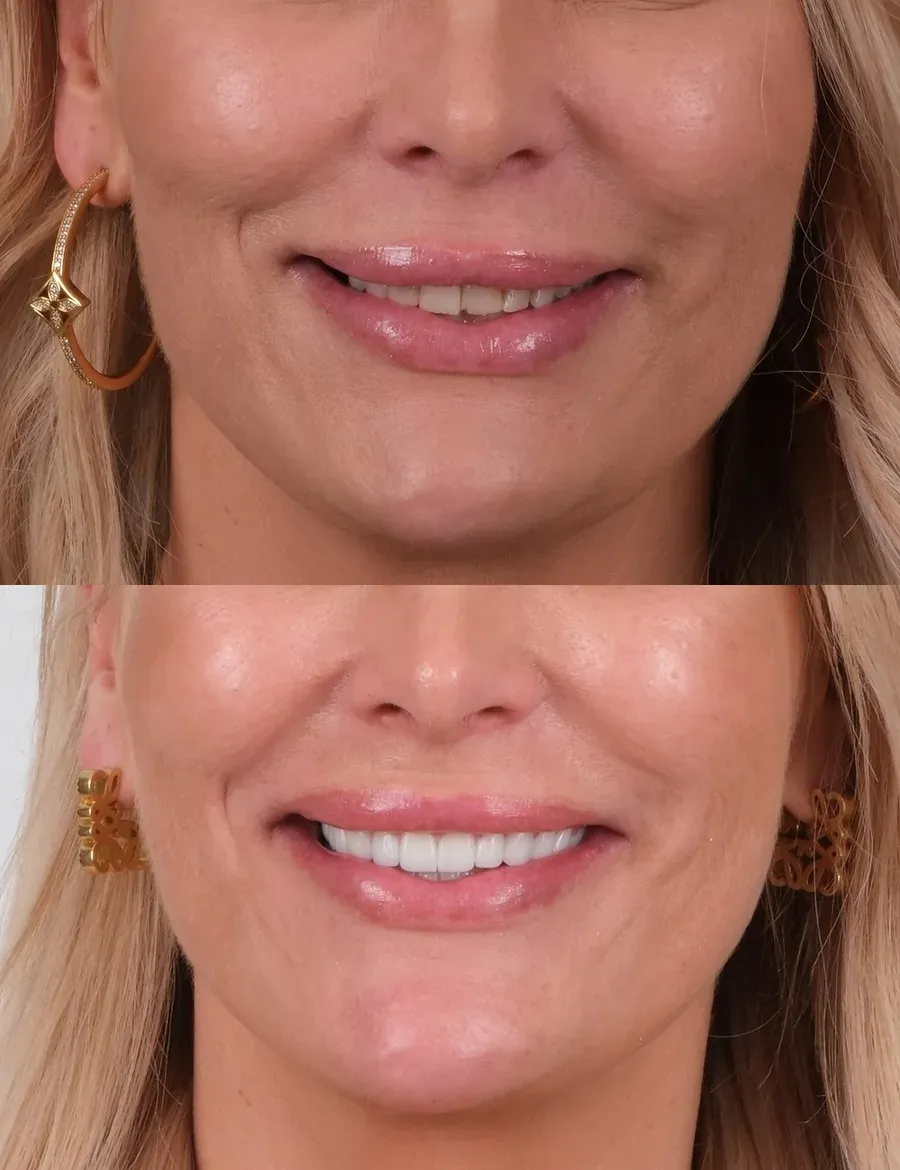 Before and after dental treatment result at DNT Klinik