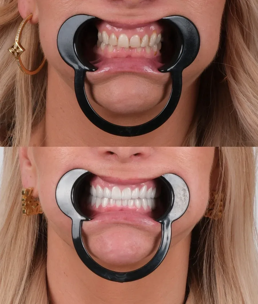 Before and after dental treatment result at DNT Klinik