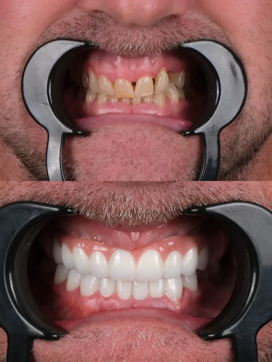 Before and after dental treatment result at DNT Klinik